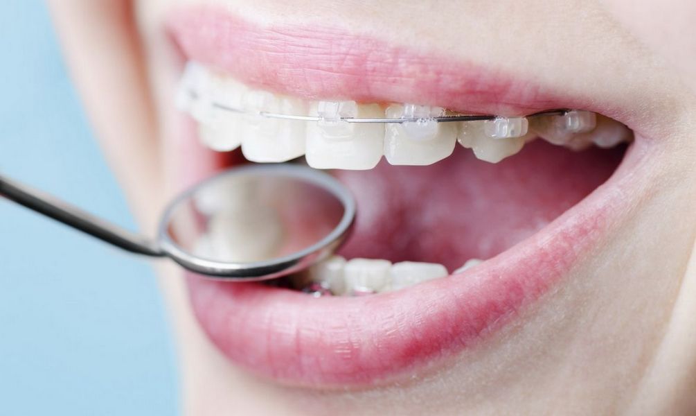Преимущества брекет-систем для ортодонтического лечения