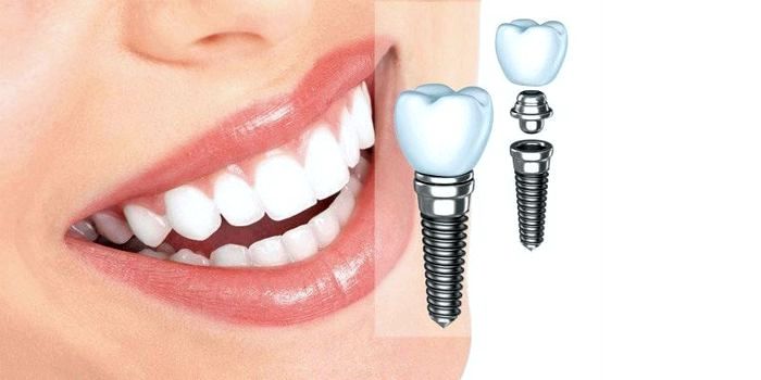 Встановлення зубних імплантів: Ключова Інформація та Процес Реалізації