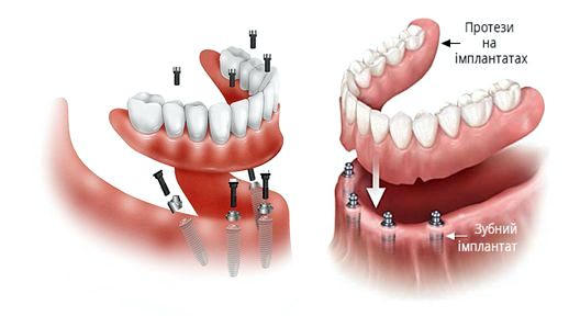 Встановлення зубних імплантів: Ключова Інформація та Процес Реалізації