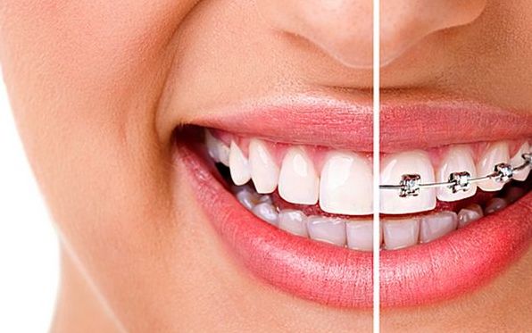 Изучение ортодонтии: От ортодонтов до брекетов